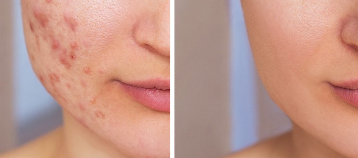 what-does-doxycycline-do-to-your-skin
